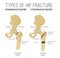 Types of hip fracture