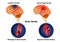 Types of human brain stroke