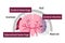 Types of human brain stroke vector illustration