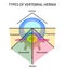 Types of location of the intervertebral hernia. Vector illustration on isolated background.