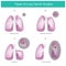 Types of Lung Cancer Surgery. Illustration.