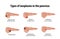 Types of neoplasms in the pancreas. Infographics.