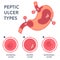 Types of peptic ulcer stomach disease infographics