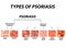 Types of psoriasis. Pustular and not pustular. Vulgar, erythroderma, erythrodermic psoriasis, persistent acrodermatitis