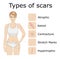 Types of scars