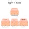 Types of scars. Acne scars. Keloid, hypertrophic, atrophic, normotrophic. The anatomical structure of the skin with acne