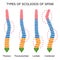 Types of scoliosis of spine.