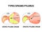 Types of spasms of the pylorus. Pylorospasm. Spastic and atonic. Pyloric sphincter of the stomach. Infographics. Vector