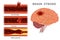 Types of stroke. Vector illustration