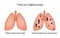 Types of tuberculosis. Miliary and disseminated pulmonary tuberculosis. Vector illustration on background