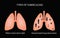 Types of tuberculosis. Miliary and disseminated pulmonary tuberculosis. Vector illustration on a black background