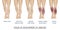 Types of varicose veins in women.