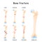 Typical bone fractures. Healthy femur and leg fracture in different stages