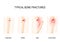 Typical bone fractures. for medical use