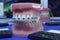 Typodont plastic moulage of human jaws demonstrating dental braces on teeth