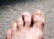 Ugly male feet and toes affected by toe nail fungus and arhtritic hammertoes