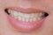 Ugly smile dental problem. Teeth Injuries or Teeth Breaking in Male