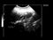 Ultrasonogram of gall bladder