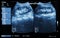 Ultrasonography of kidney : show left kidney stone ( 2 image for compare )