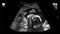 Ultrasonography of pregnant woman