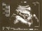 Ultrasound baby feet
