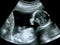 Ultrasound of baby in mother\'s womb