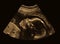 Ultrasound of baby in pregnant woman