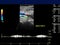 Ultrasound doppler of popliteal vien for finding deep vein thrombosis.