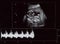 Ultrasound of fetus