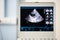 The ultrasound screen with the image of a heart scan with a doppler