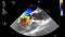 Ultrasound transesophageal examination of the heart.