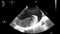 Ultrasound transesophageal examination of the heart.