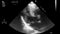 Ultrasound transesophageal examination of the heart.