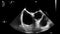 Ultrasound transesophageal examination of the heart.