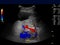 Ultrasound upper abdomen showing flow in common bile duct .