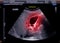 Ultrasound upper abdomen showing  gallbladder for diagnosis gallbladder stone