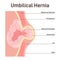 Umbilical hernia. Part of the intestine bulges through the opening