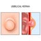Umbilical hernia and umbilicus