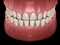 Underbite dental occlusion  Malocclusion of teeth . Medically accurate tooth illustration