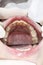 Unhealthy child denture, tartar on frontal teeth