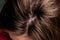 Unhealthy head skin. Problem hair loss, dandruff