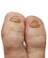 Unhealthy toes with toenails affected by fungal disease
