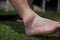 An unpleasant foot injury in a young football player