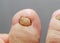 Unpleasant toes with toenails affected by fungal disease