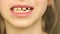 Unrecognizable girl touching loose tooth, close-up, lower part of face, 7 year old girl shows milk teeth and growing permanent.
