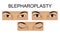 Upper eyelid blepharoplasty