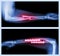 Upper image : Fracture ulnar and radius (Forearm bone) , Lower image : It was operated and internal fixed with plate and