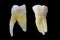 Upper molar