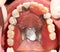 Upper Prosthesis In Mouth