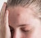 Upset teen girl with problematic skin posing on a white background